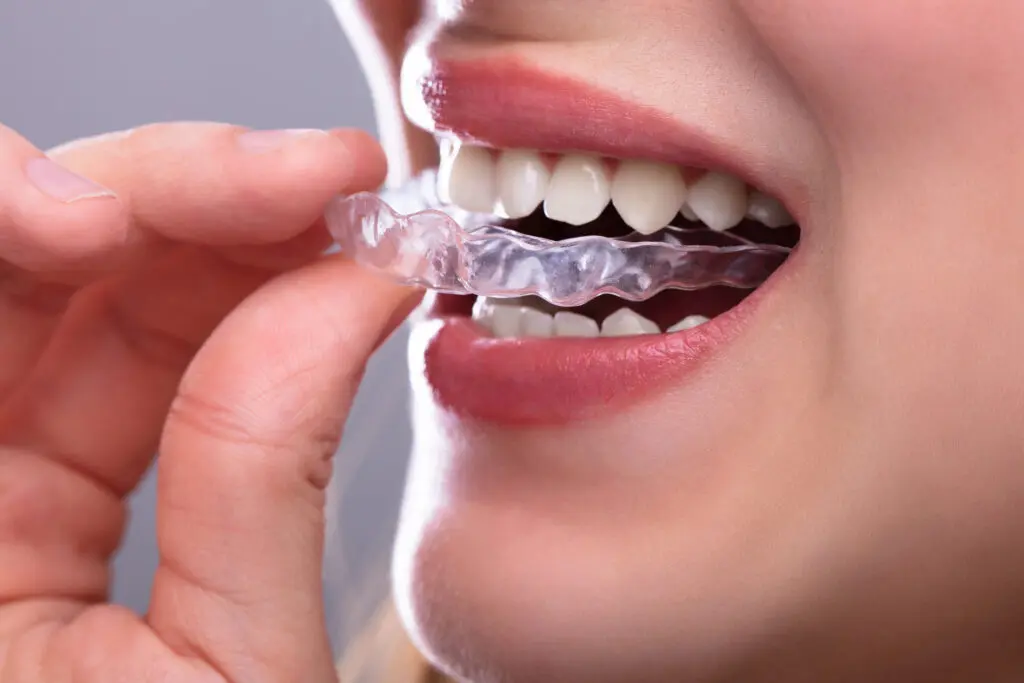 Close-up of a person inserting a clear aligner, showcasing the comfort and invisibility of Invisalign treatment and invisalign cost in tallahassee, fl