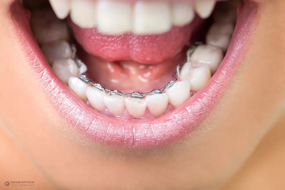 Close-up of an open mouth showing braces on the lower teeth. Lips have light pink lipstick.