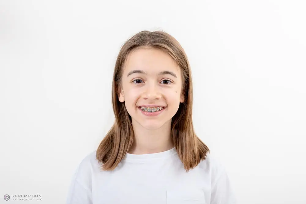 A young person with straight, shoulder-length hair and braces smiles at the camera as an example to show how to fix overbite in Tallahassee, FL, wearing a white t-shirt against a plain white background.