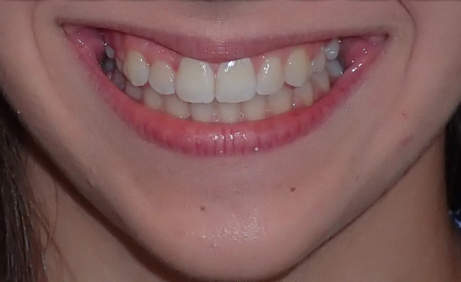Smiling person after braces at Redemption Orthodontics in Tallahassee, FL, showing spaced, uneven upper front teeth and gums.