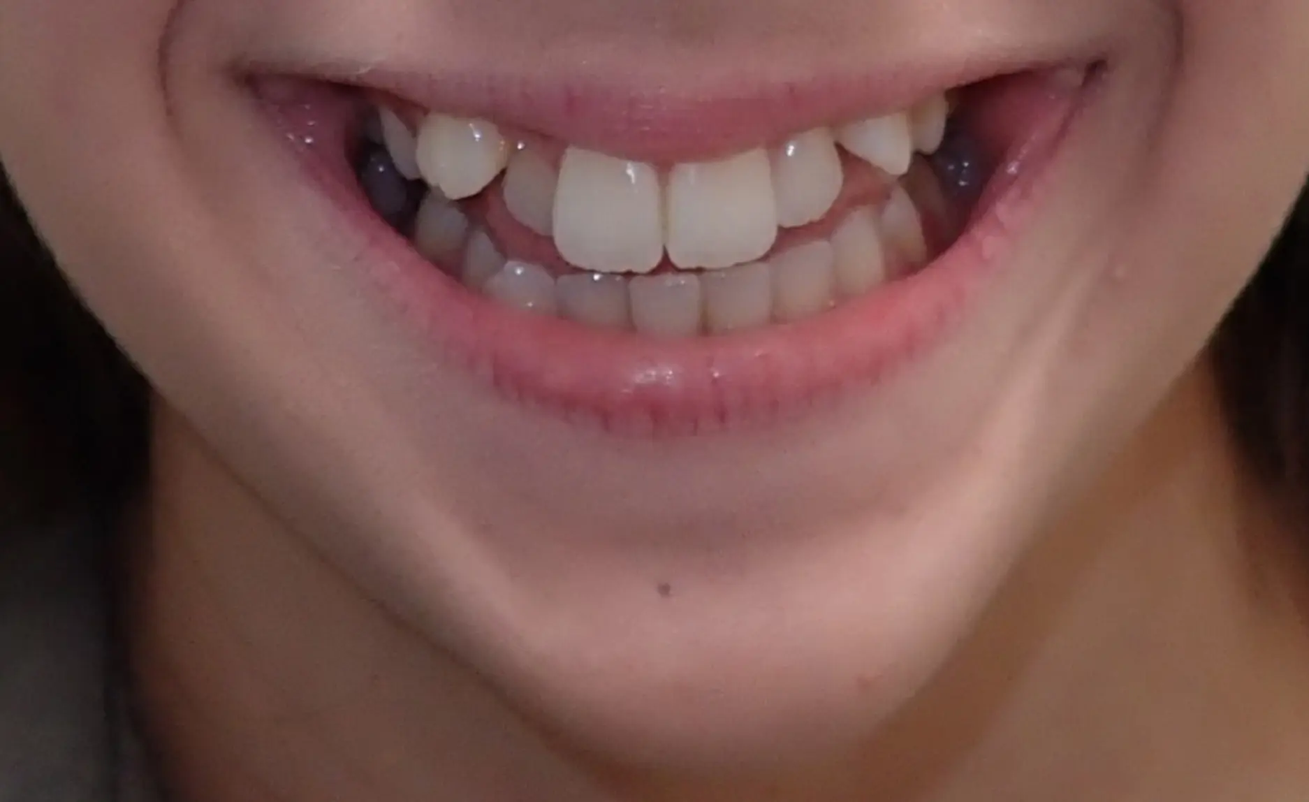A close-up smile showing crowded, misaligned teeth before braces at Redemption Orthodontics in Tallahassee, FL.