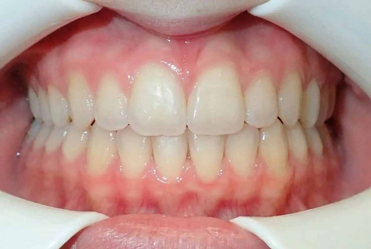 In Tallahassee, FL, Redemption Orthodontics showcases Invisalign results: clean, aligned teeth and healthy gums with cheek retractor.