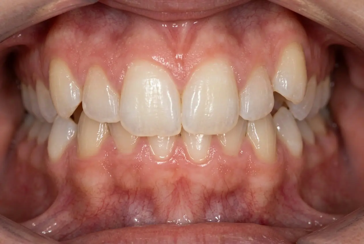 Open mouth shows mildly crowded, misaligned teeth with healthy gums at Redemption Orthodontics in Tallahassee, FL—Invisalign before.