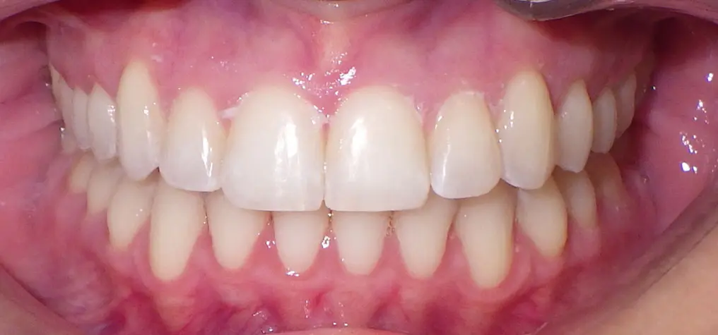 Clean, well-aligned teeth and healthy gums after Invisalign at Redemption Orthodontics in Tallahassee, FL, close-up view.