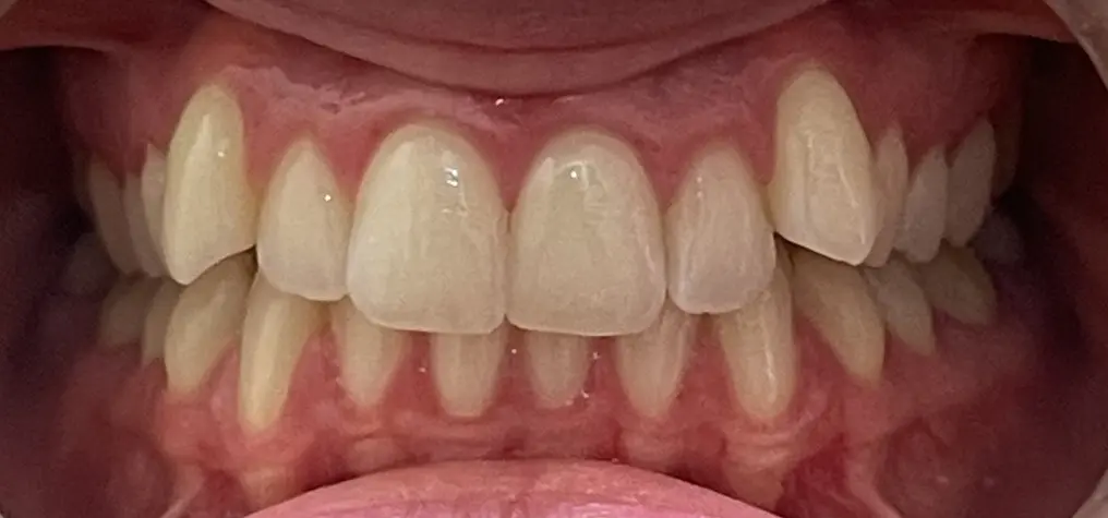 Mild teeth crowding and visible gums shown before Invisalign at Redemption Orthodontics in Tallahassee, FL.