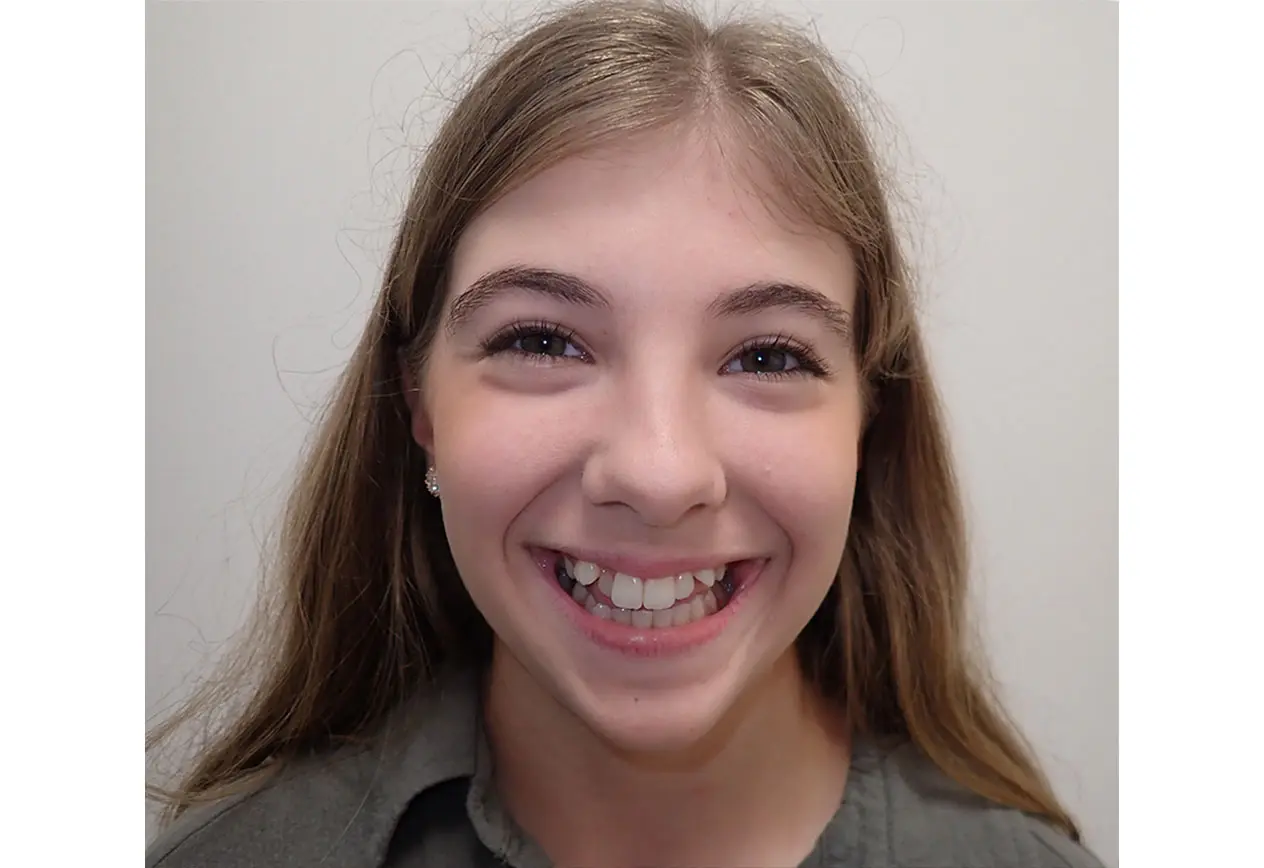 Smiling girl with long light brown hair shows her teeth before braces at Redemption Orthodontics in Tallahassee, FL.