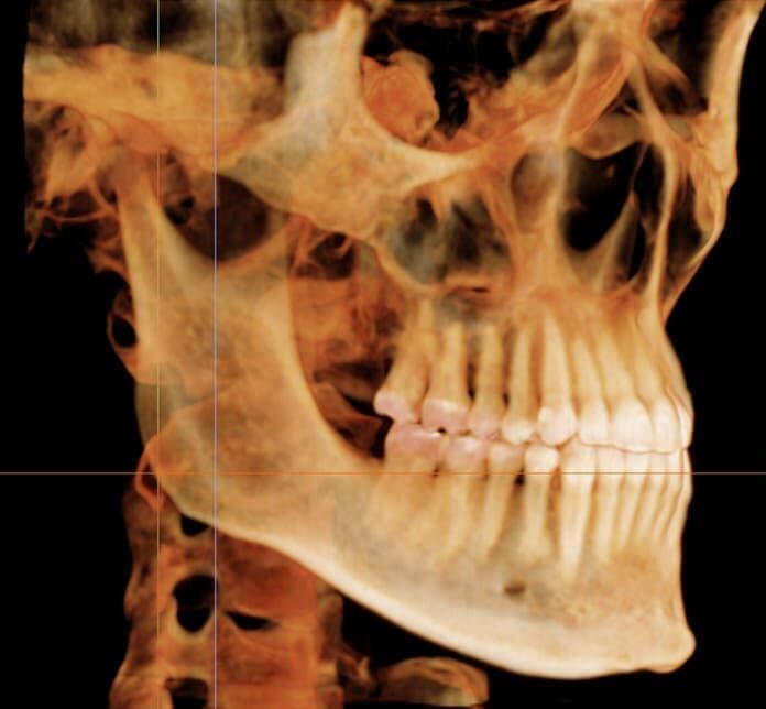 Side-profile 3D X-ray of human skull, teeth, and jaw structure at Redemption Orthodontics in Tallahassee, FL.